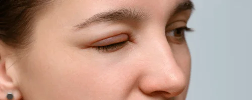 Felső szemhéjplasztika